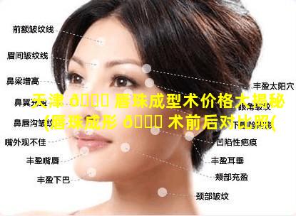 天津 🍀 唇珠成型术价格大揭秘(唇珠成形 🐋 术前后对比照(图))